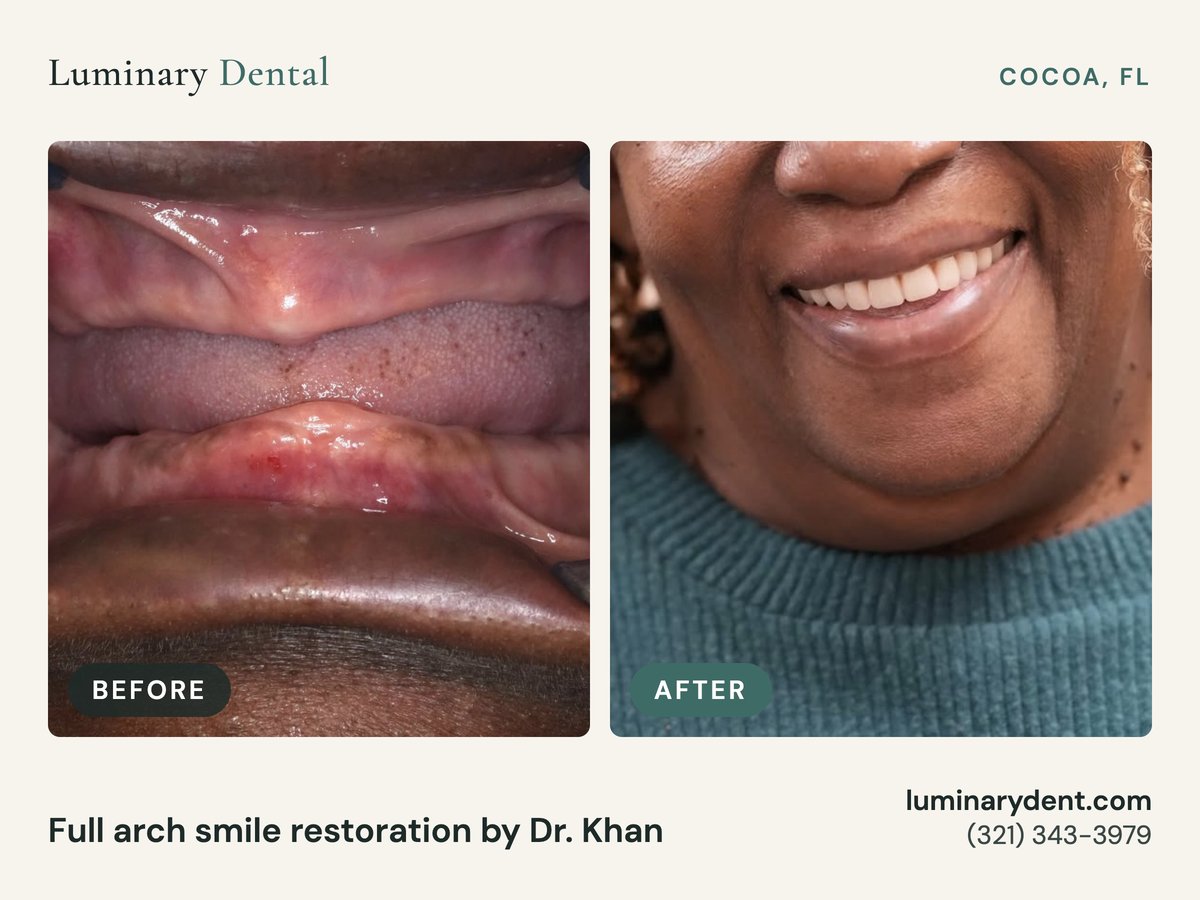 Before and after full-arch smile restoration by Dr. Khan at Luminary Dental in Cocoa, FL
