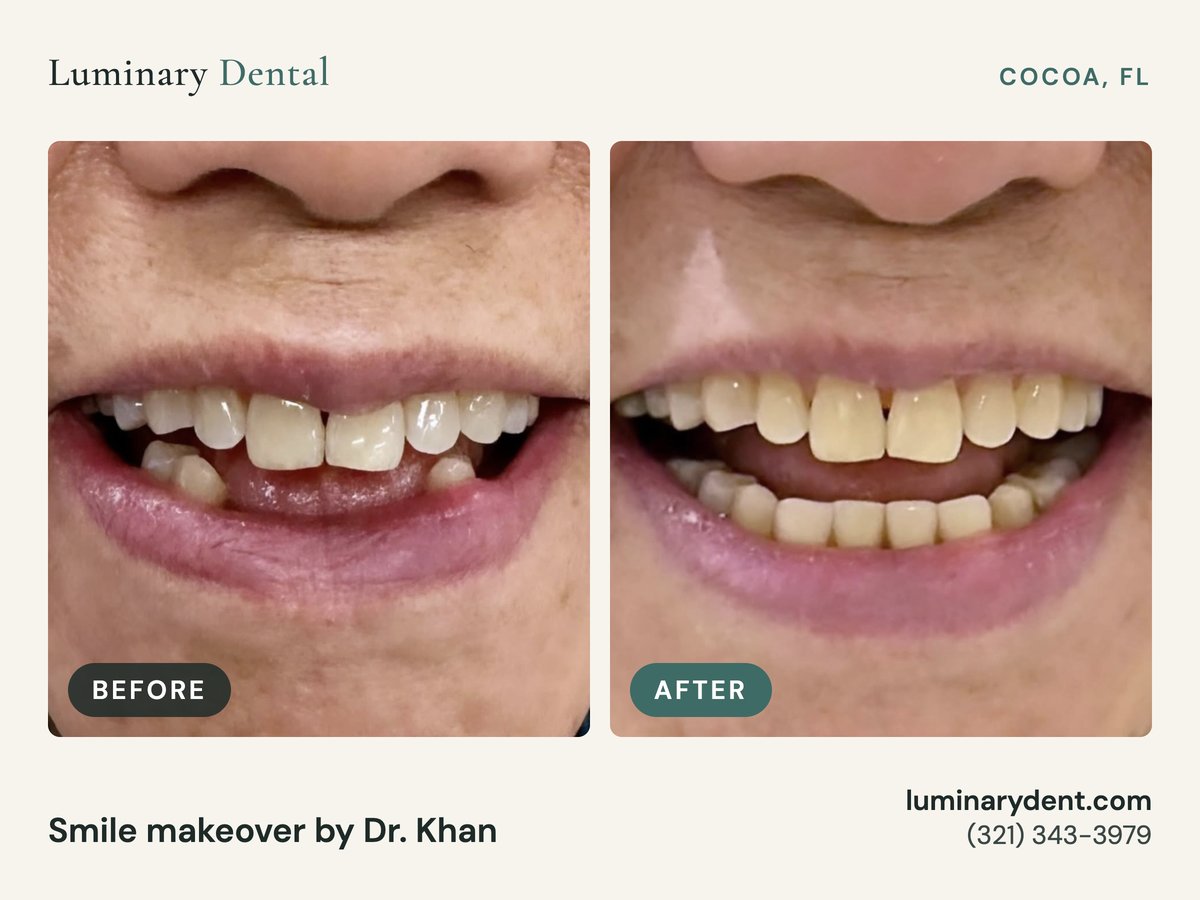 Before and after smile makeover replacing missing teeth by Dr. Khan at Luminary Dental in Cocoa, FL