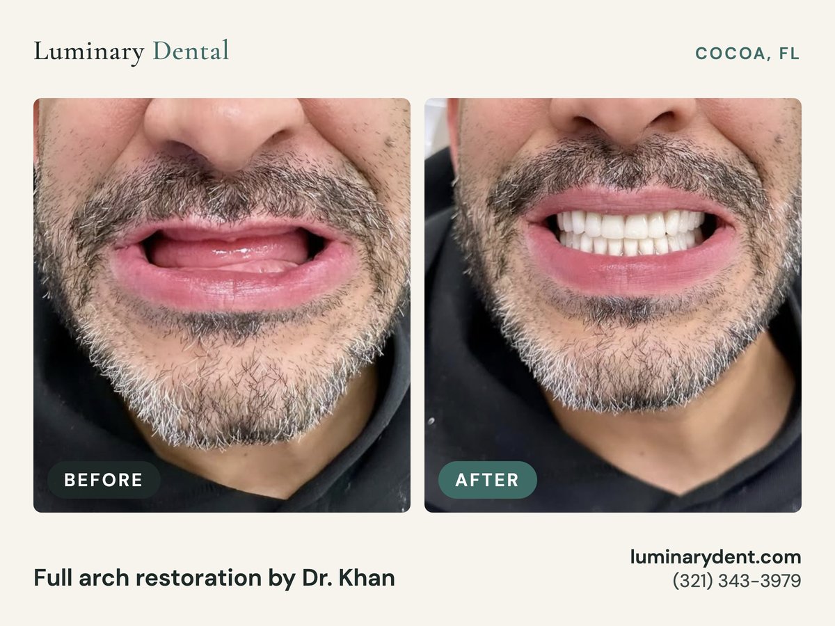 Before and after full-arch dental implant restoration by Dr. Khan at Luminary Dental in Cocoa, FL